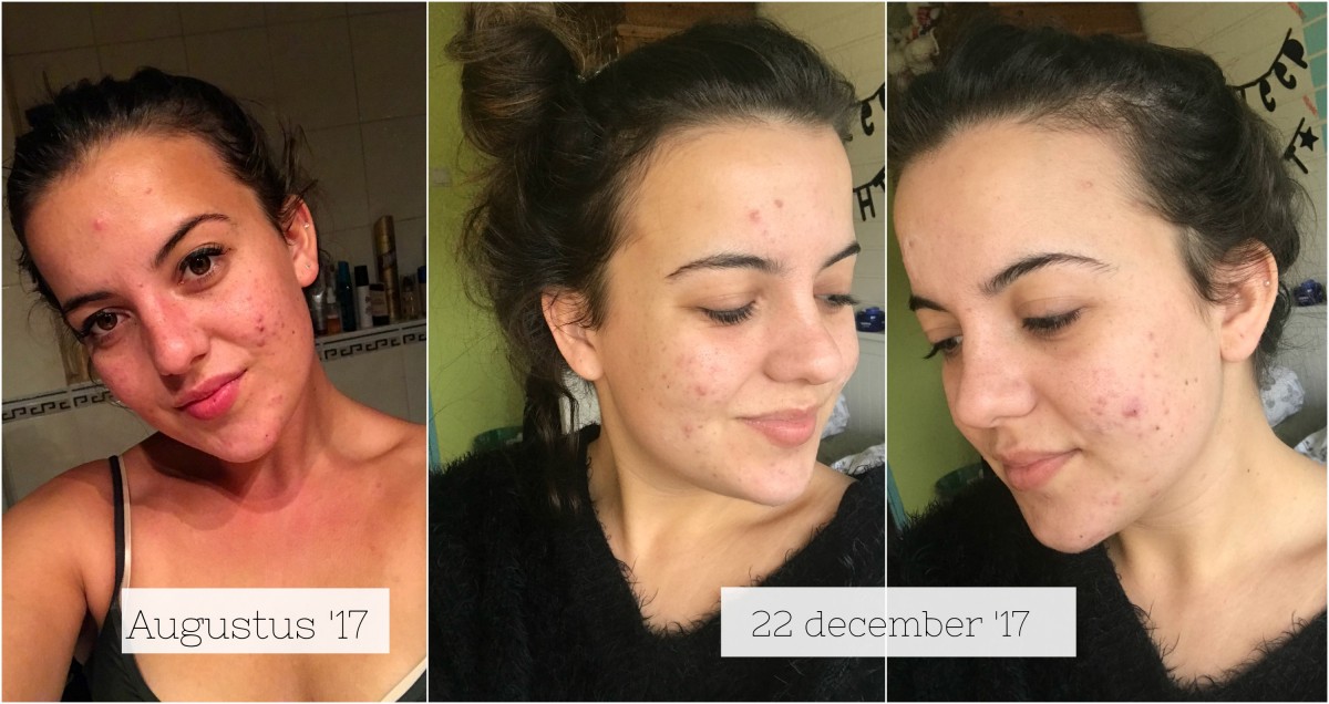 Sijpelen Bewolkt Bloeien Helpt benzoylperoxide tegen acne? (+ voor- en na foto's!) - iMarjoleine